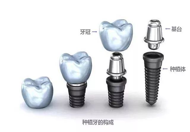 種植體(tǐ)的結構是什麽 種植體(tǐ)有(yǒu)哪些分(fēn)類