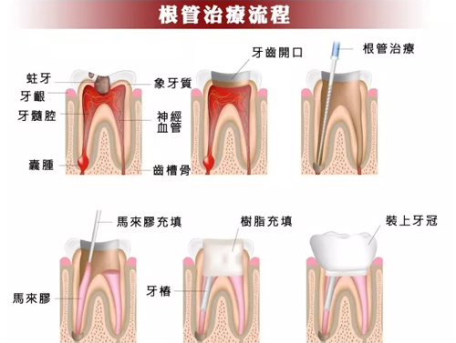 根管治療為(wèi)什麽那麽貴