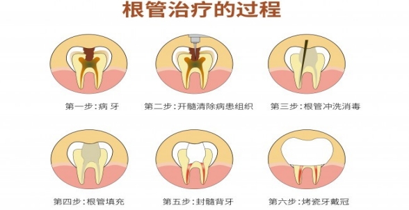 什麽是顯微根管治療 根管治療後為(wèi)何要用(yòng)牙冠修複