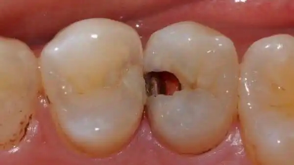 死髓牙可(kě)以做正畸治療嗎