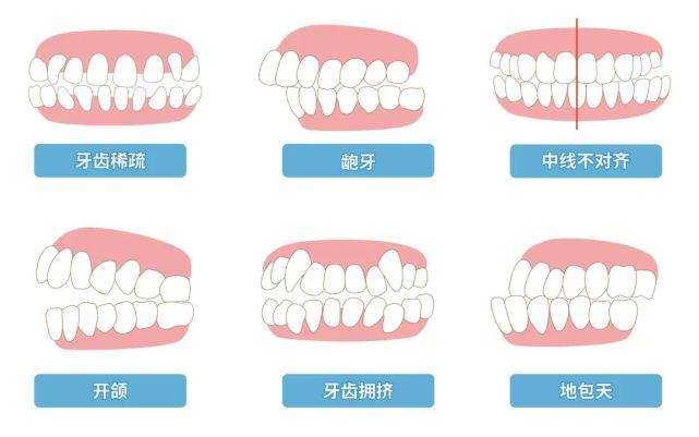 常見牙颌畸形的矯治方法有(yǒu)哪些