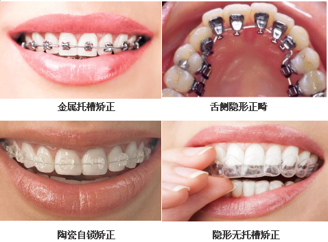正畸矯治器有(yǒu)什麽類型