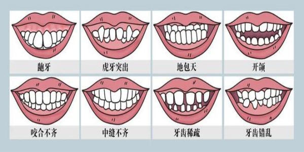 遺傳因素引起的錯颌牙是什麽
