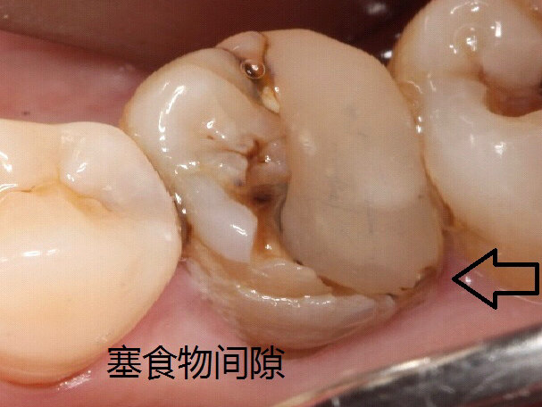 塞牙的常見原因是什麽 如何治療