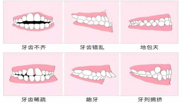 牙颌畸形會有(yǒu)哪些危害