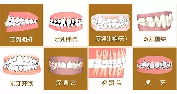 錯颌畸形的矯治方法有(yǒu)哪些
