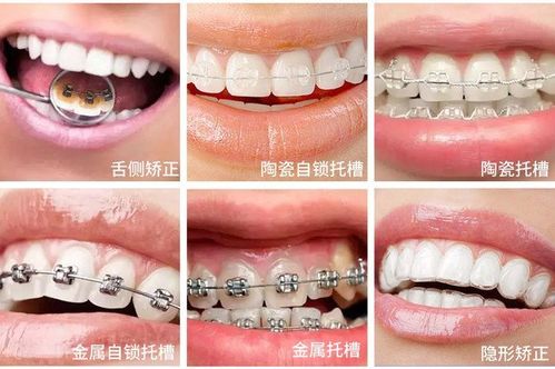 常用(yòng)的正畸矯治器有(yǒu)哪些