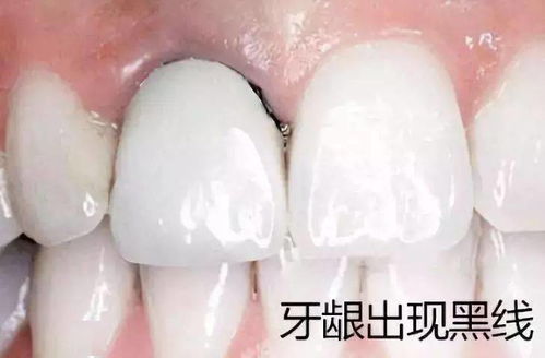 牙科(kē)小(xiǎo)知識：如何判斷一個假牙或修複體(tǐ)是否合格？