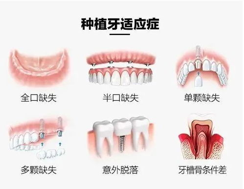 種植牙成功的标準是什麽？缺牙人群都首選種植牙嗎？