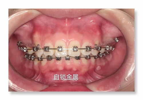 正畸知識：如何緩解正畸過程中(zhōng)的牙齒疼痛和敏感？