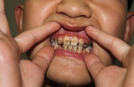 齲齒的預防方法有(yǒu)哪些？如何保持口腔健康和清潔？